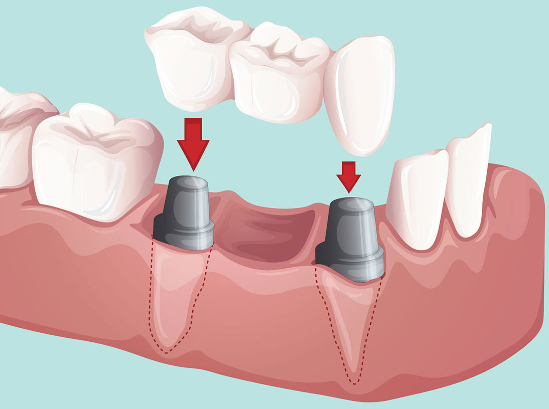 Dental Implants