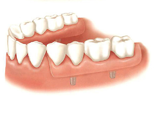 Dental Implants
