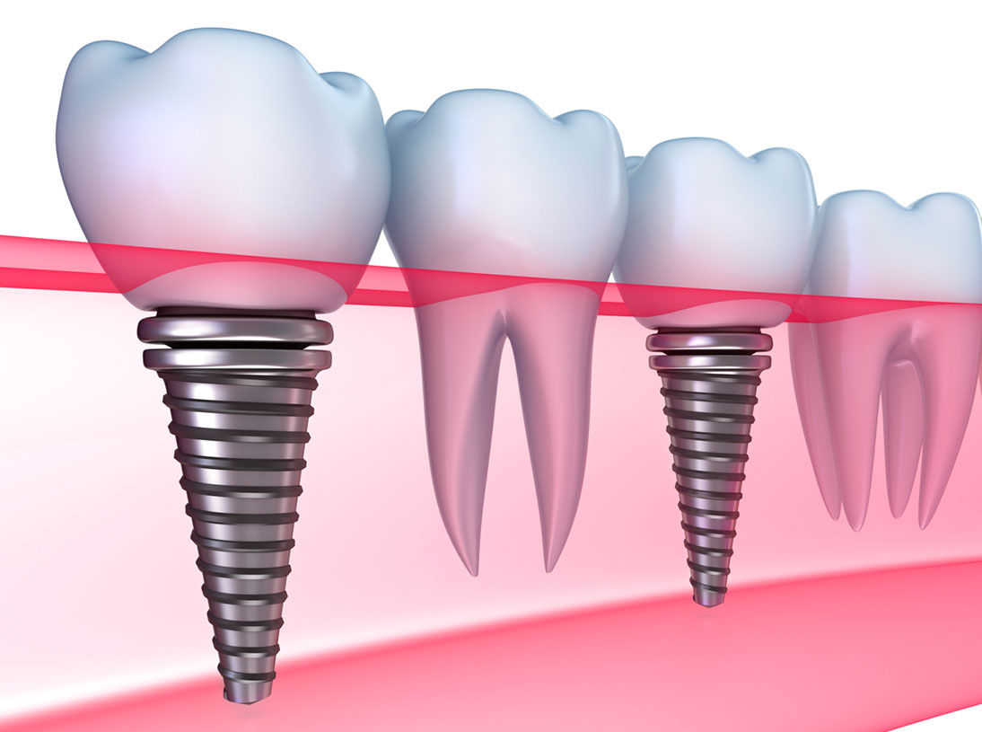 Dental Implants